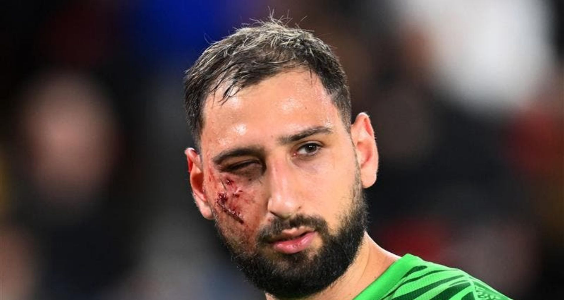 Donnarumma Pendarahan Saat Melawan Monaco